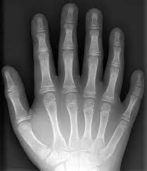 Six Fingers