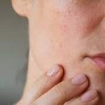 MILIALAR: Understanding a Common Skin Condition